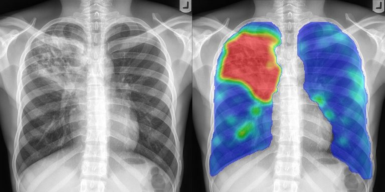 Analysis of X-ray Images